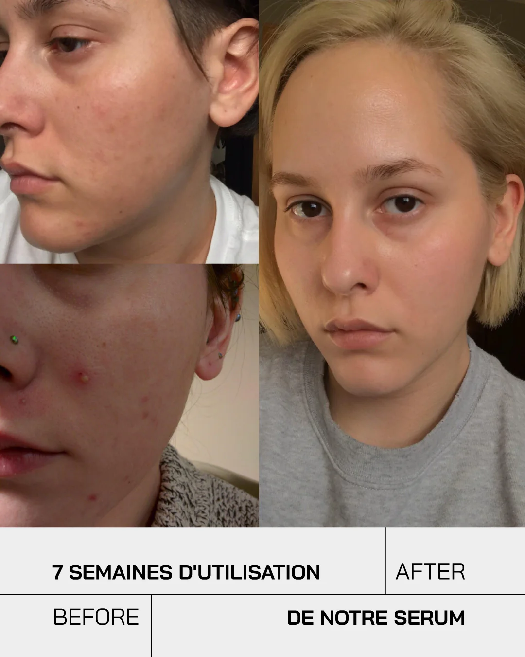 Touché Acide Salicylique – Image 3